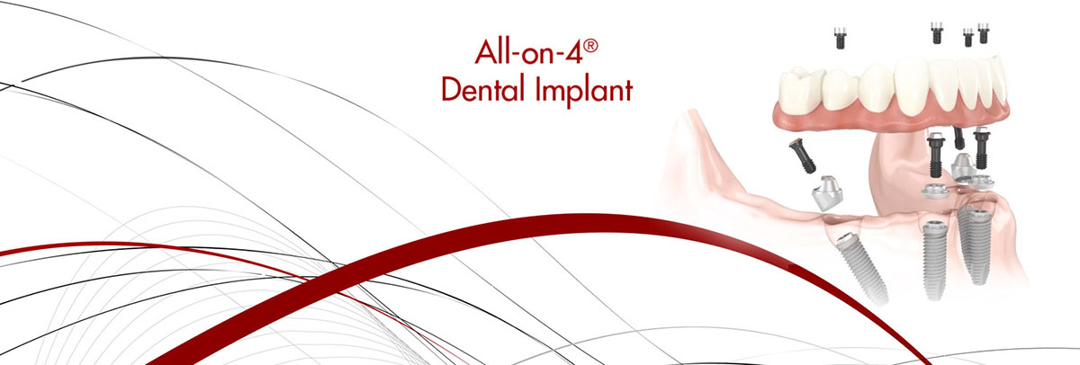 McLean All-on-4 Dental Implants