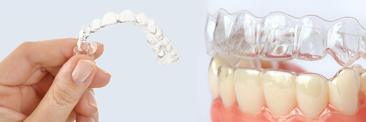 McLean Alternative to Braces for Teens