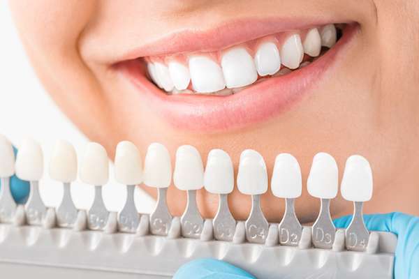 Ask a Cosmetic Dentist: What Are Veneers from Oak Tree Dental in McLean, VA