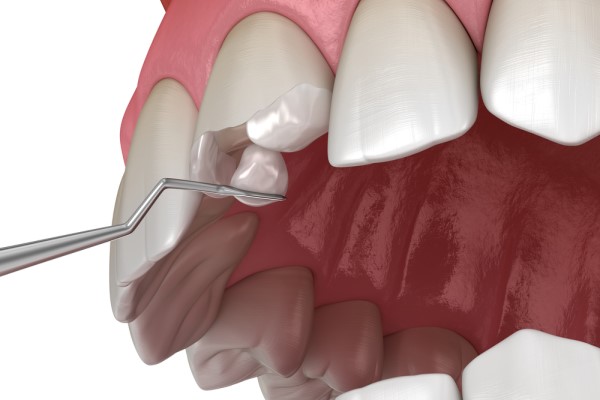 How To Know If You Have A Crack In Your Dental Filling?