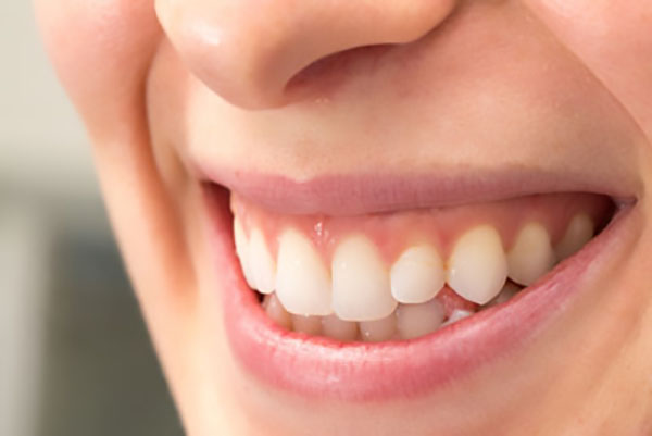 Can You Fix Receding Gums With Cosmetic Dentistry?