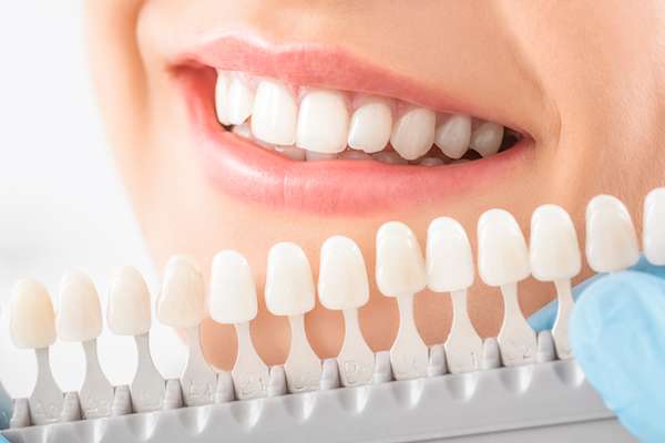 Caring for Veneers After a Cosmetic Dentist Treatment from Oak Tree Dental in McLean, VA