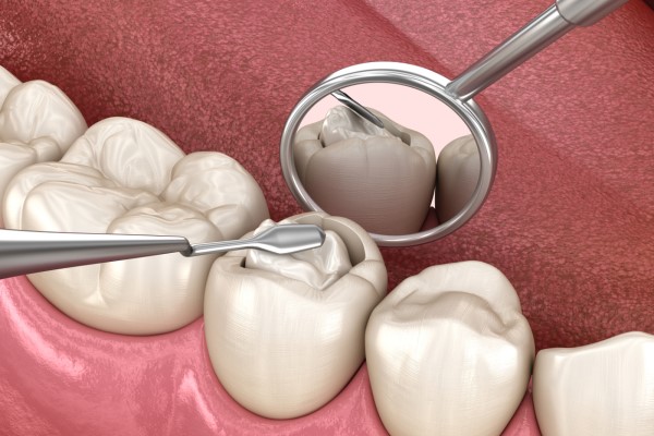 How A Dental Filling Can Treat Tooth Decay