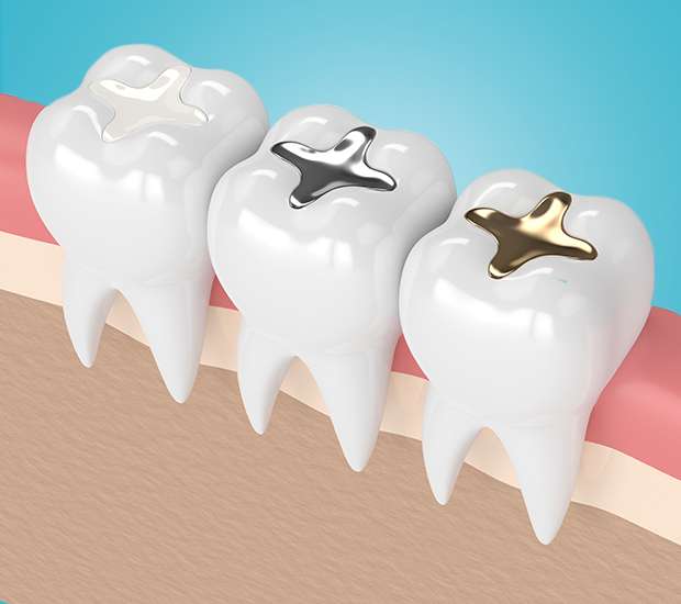 McLean Tooth Colored Fillings
