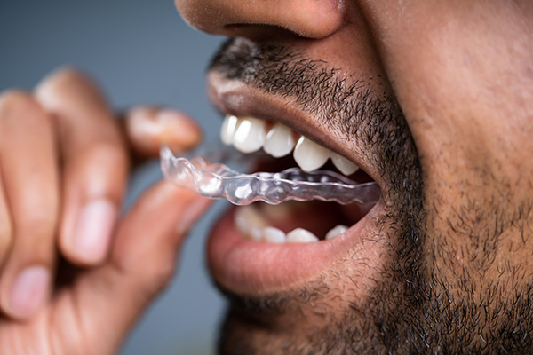 A Cosmetic Dentist Explains Benefits of Clear Aligners from Oak Tree Dental in McLean, VA