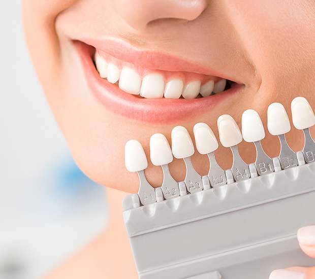 McLean Dental Veneers and Dental Laminates
