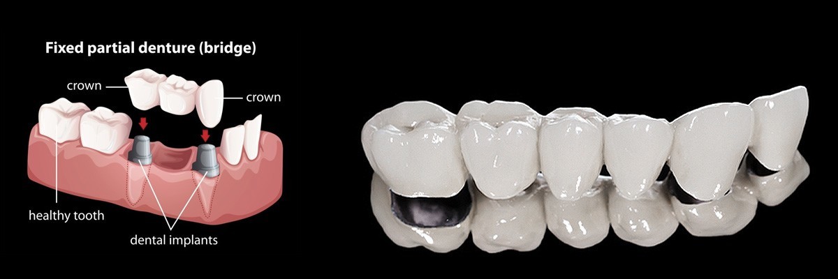 McLean Dentures
