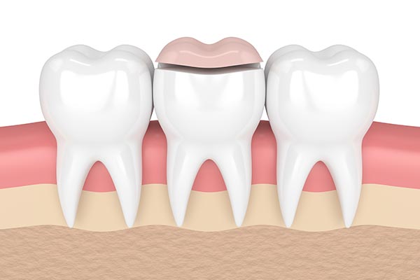How a Cosmetic Dentist Can Place Inlays and Onlays from Oak Tree Dental in McLean, VA