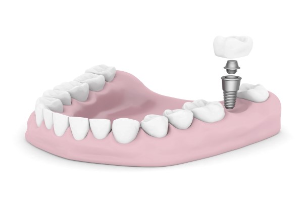 FAQs About Implant Dentistry