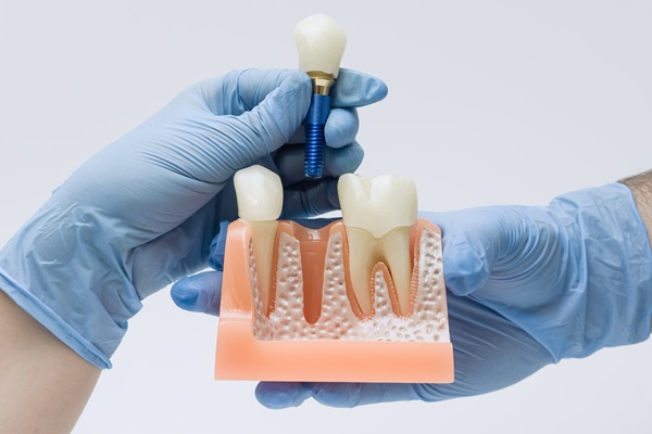 An Implant Dentist Discusses Bone Growth And Healing After Placement