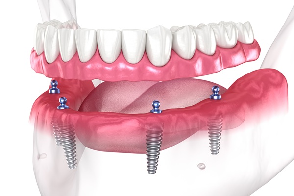 A Guide To The Implant Supported Dentures Procedure