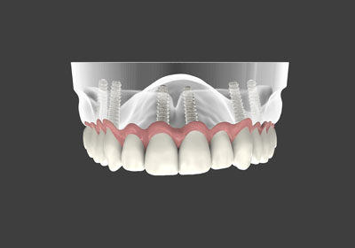 Implant Supported Dentures