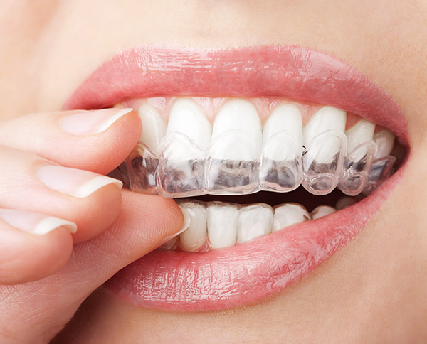 Invisalign Ashburn, VA