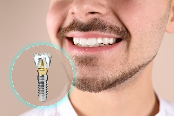 Finding The Replacement Option For Your Missing Tooth