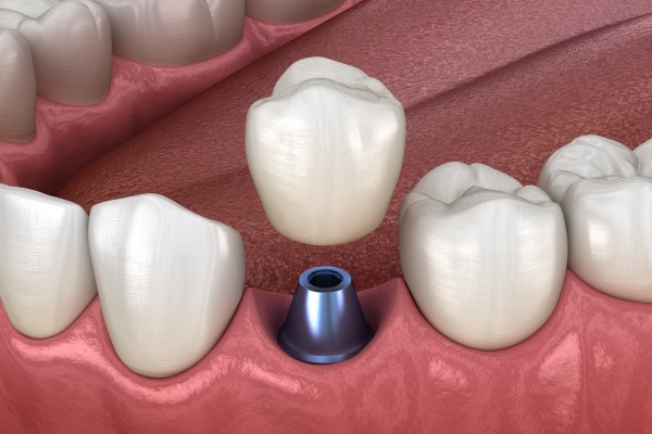 Options For Replacing Missing Teeth McLean, VA