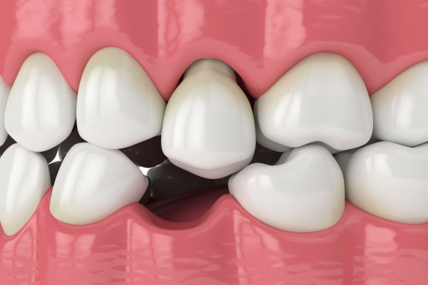 A Cosmetic Dentist Can Replace A Missing Tooth