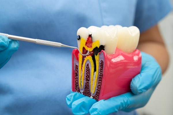 Debunking Root Canal Myths: How This Procedure Protects Oral Health