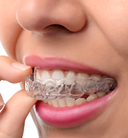 Clear Aligners - Almost Invisible Braces McLean, VA