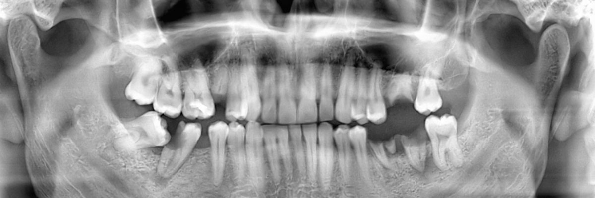 McLean Wisdom Teeth Extraction